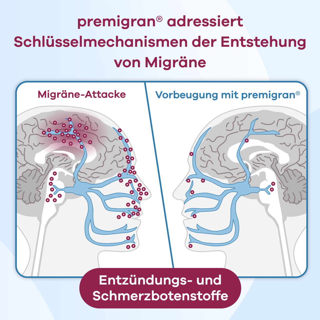 Infografik. premigran adressiert Schlüsselmechanismen der Entstehung von Migräne. Ein Vergleich zweier Kopfprofile zeigt links eine Migräne-Attacke mit vielen roten Punkten entlang der Nervenbahnen, welche Entzündungs- und Schmerzbotenstoffe darstellen. Rechts zeigt die Vorbeugung mit premigran deutlich reduzierte Botenstoffe im Kopfbereich.